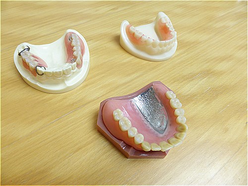 入れ歯にはどのような種類があるのか？ | 祖師ヶ谷大蔵駅すぐの歯医者｜谷村歯科医院｜祖師ヶ谷大蔵駅から徒歩10秒